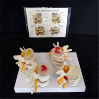 Anatomical Human Lumbar Vertebrae Degenerative Disc Disease Model Medical