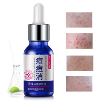 Anti Acne Treatment Essence Oil Control Water Replenish Repair Moist Facial Skin Care Lighten Mark
